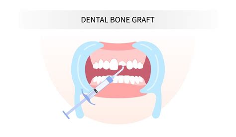 Understanding Bone Grafting At The Time Of Tooth Extraction What You