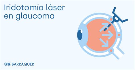 Tecnica Di Iridotomia Laser Per Il Glaucoma