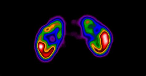 SPECT Bone and DTPA Scan in Lucknow | Nuclear Medicine