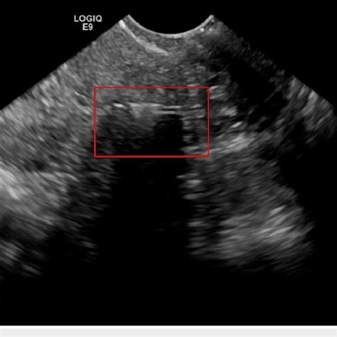 Intrauterine device fragment redemonstrated on endovaginal ultrasound ...