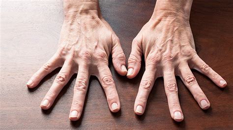 Hand Exercises For Rheumatoid Arthritis Ra Relief Everyday Health