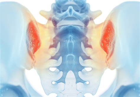 VIBE-MRI Technique Detects More Sacroiliac Joint Erosions in AxSpA ...