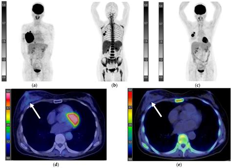 Tomography Free Full Text Comparison Of 18f Fluorothymidine