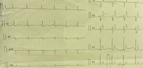 Ecg 15 mins after admission showing classical de winters pattern | Download Scientific Diagram