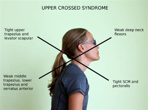 Common Muscle Imbalances Upper Crossed Syndrome And Lower Crossed