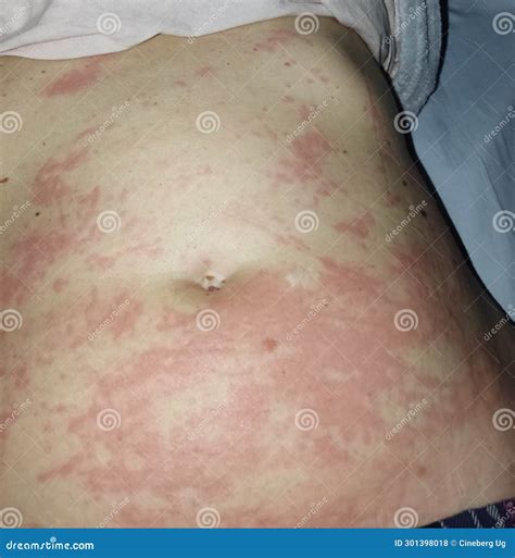 Dermatitis stock photo. Image of allergies, dermis, psoriasis - 301398018