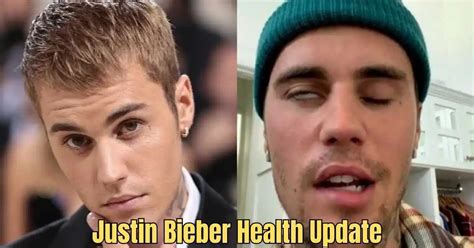 Justin Bieber Health Update Fight Against Ramsay Hunt Syndrome Diagnosis