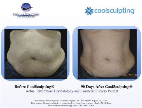 Coolsculpting Before And After Photos Lost That Extra Belly Fat By Using Coolsculpting To Freeze