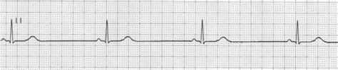 Análisis Del Ritmo Cardíaco Cerebromedico