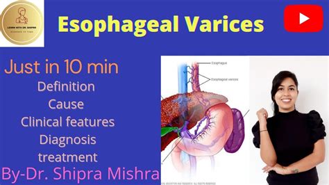 Esophageal Varices In Hindi Cause Symptoms Diagnosis Treatment Dr | Hot ...