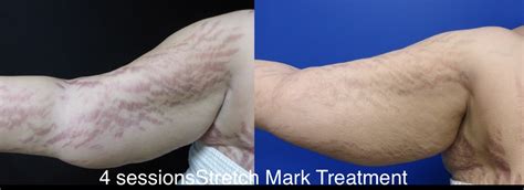 Patient 24560994 Stretch Mark Removal Gallery Before After Photos