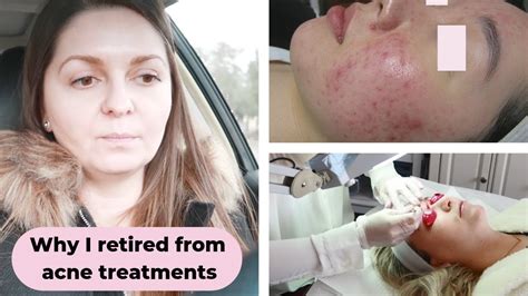 Vlog Retired From Acne Treatments Accutane Dry Lips Remedy Youtube