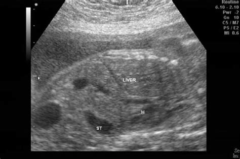 Diaphragmatic Hernia Ultrasound