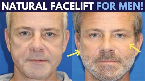 Forehead Lift Before And After Men