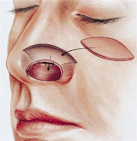 Techniques Of Columellar And Alar Nasal Reconstruction Operative