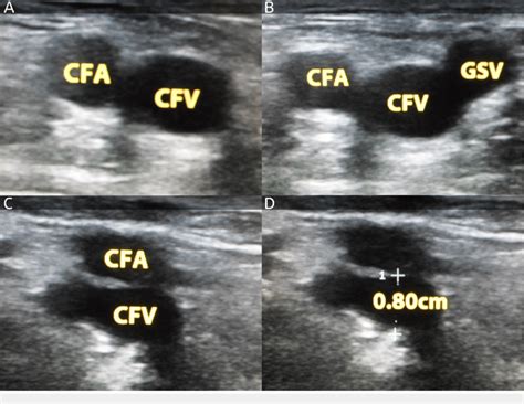 Deep Femoral Vein Ultrasound