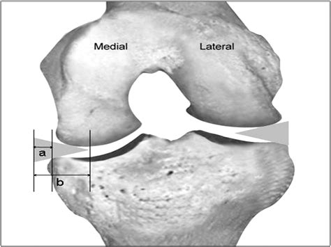 A New Arthroscopic Classification Of Degenerative Medial Meniscus Root