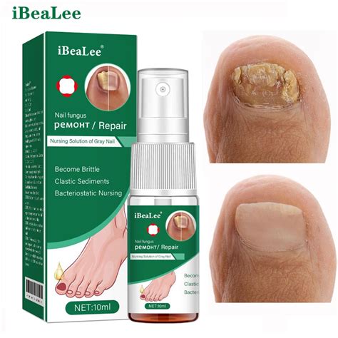 Tanio Ibealee Dni Leczenie Grzybicy Paznokci Serum Onychomycosis