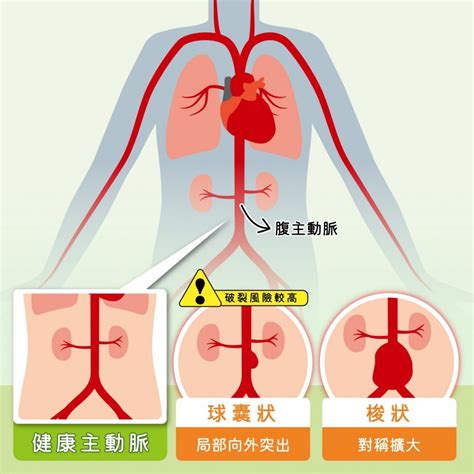 男子時常腰痠背痛 一檢查竟是腹主動脈瘤 自由健康網