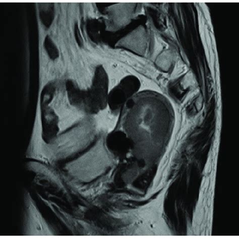 Magnetic Resonance Imaging Of The Pelvis T2 Weighted Imaging Revealed