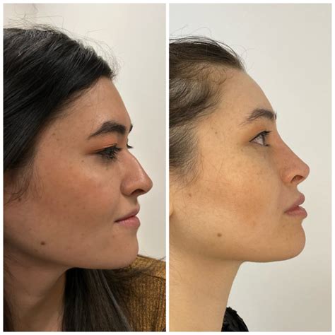 Non Surgical Rhinoplasty Nose Filler Derma Models