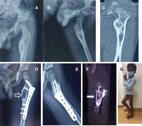 Osteoid Osteoma Femur