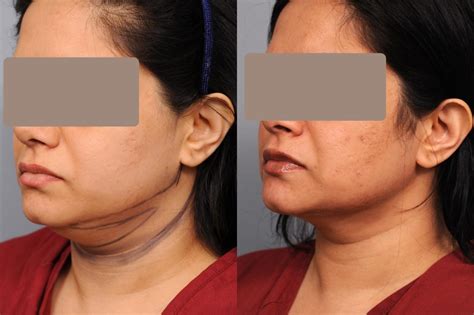 Neck Liposuction With Smartlipo In New York