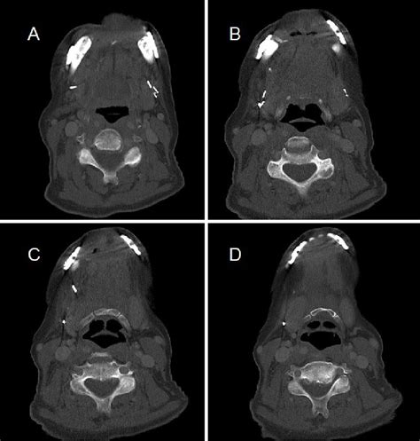 Figure 2 From Expanding Use Of Osseointegrated Implantation Using 3 Dimensional Surgical