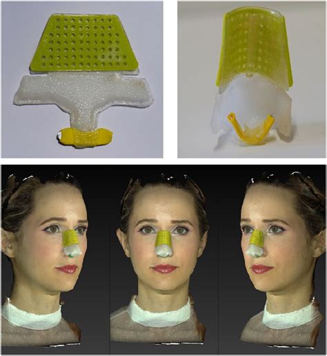 A Novel External Nasal Splint Adam Honeybrook Charles R Woodard