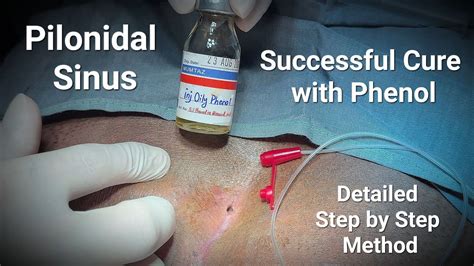 Pilonidal Sinus Management With Phenol Dr Tayyab Riaz Ch Youtube