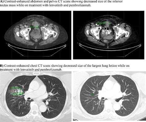 A Contrast Enhanced Abdomen And Pelvis Ct Scans Showing Decreased Download Scientific Diagram