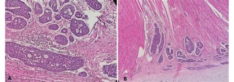 A Cribriform Growth Pattern Displaying Several Prominent Pseudocysts