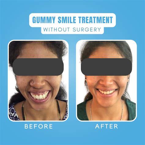 Gummy Smile Treatment In Kochi Kerala Vallamattom Advanced Orthodontics