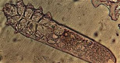 Demodex Mites Treatment in Humans ~ DEMODICOSIS