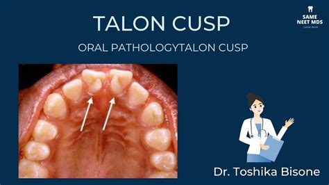 Talon Cusp Oral Pathology Neet Mds Youtube