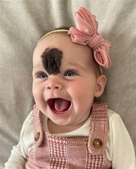 Parents Sent Daughter To Surgery To Remove Rare Birthmark People