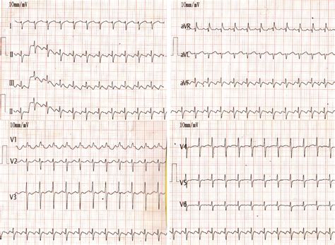 Atrial Flutter Ecg Strip