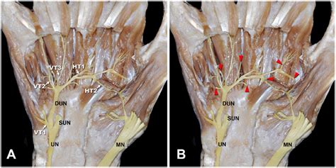 Ulnar Nerve Sensory Distribution