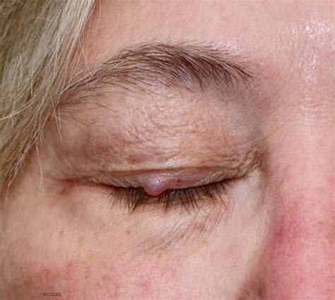 Eyelid Lumps And Bumps Desert Health Hot Sex Picture