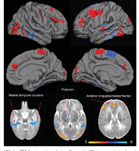 Figure 1 From Impact Of Sex And Gonadal Steroids On Neonatal Brain Structure Semantic Scholar