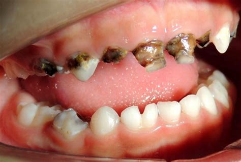 Dentes Cheio De Bicho - Após ver dentes podres em criança de 3 anos, dentista repreende a mãe ...