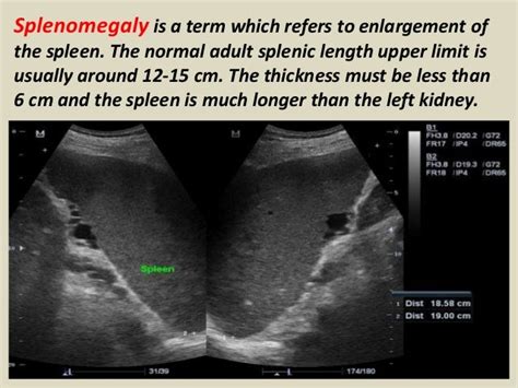 Enlarged Spleen Ultrasound