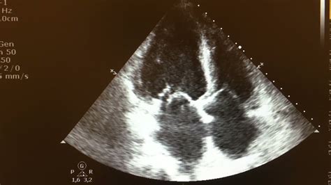 Anterior Mitral Valve Leaflet Chordae Rupture With Severe Mitral