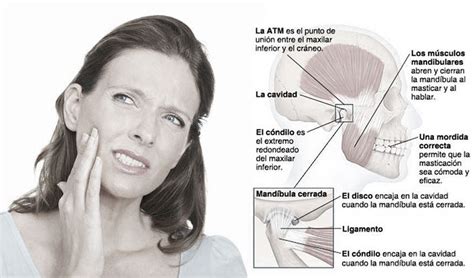 Articulación Temporomandibular Trastornos en la ATM y su tratamiento