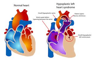 Hypoplastisches Linksherz Syndrom