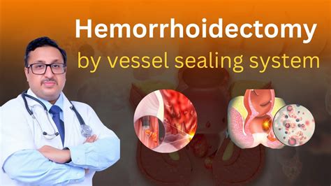 Advanced Treatment Grade 3 Hemorrhoids Piles Bawasir Vessel