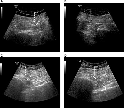 Ultrasound Appears To Be A Reliable Technique For The Diagnosis Of