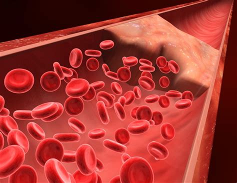 Blood Clot Treatment