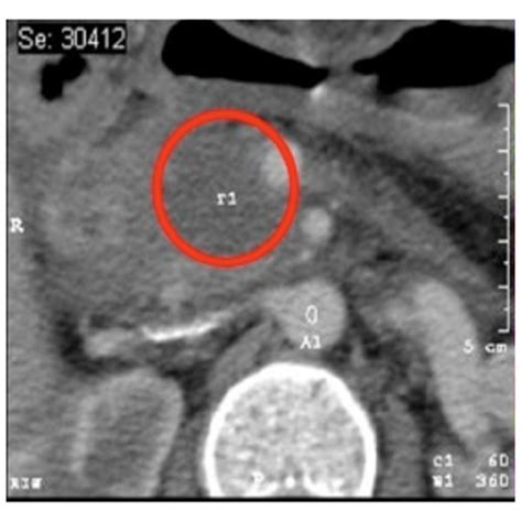 A Preoperative Ct Scan Of A Locally Advanced Pancreatic Cancer B