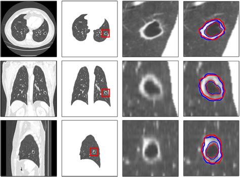 Lung Nodules Segmentation Results For A Cavity Nodule Subject Original